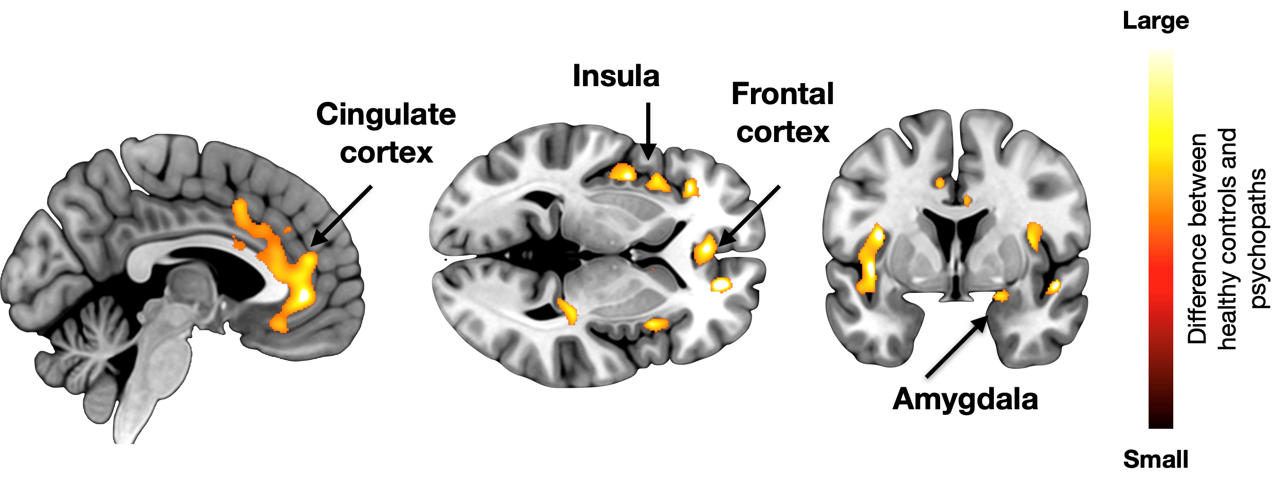 Brain areas with decreased density in psychopaths. From left to right: Cingulate cortex, Insula, Frontal cortex, Amygdala.