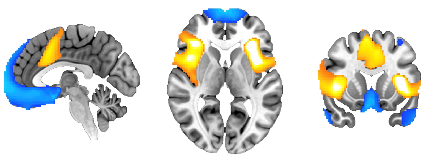 Tutkijoiden tunnistamat aivoverkostot merkittynä aivokuviin sinertävällä ja kellertävällä värillä.