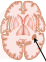 Glioblastoma PME-1, HDAC4