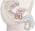 Prostate Cancer Gene variants