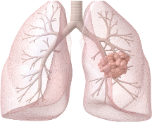 Solid cancers Prognostics &  Therapy