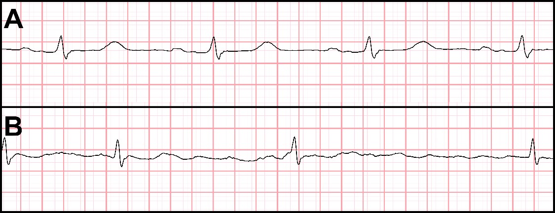 Kaksi sydänfilmiiä, A ja B.