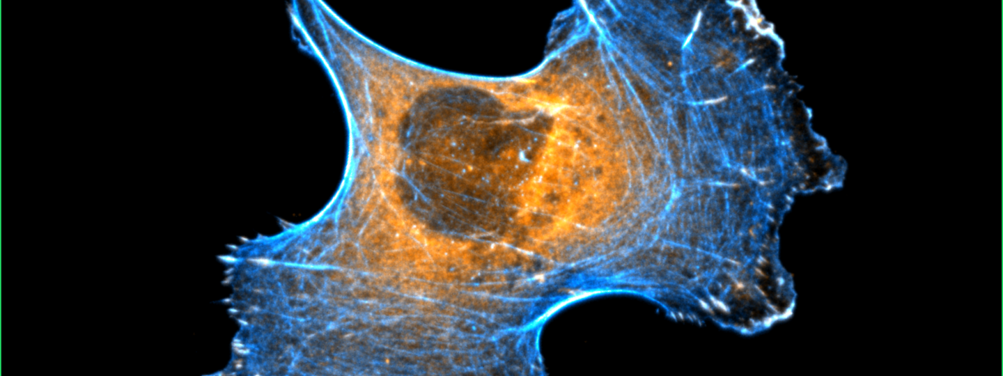 Oranssilla ja sinisellä värjätty rintasyöpäsolu