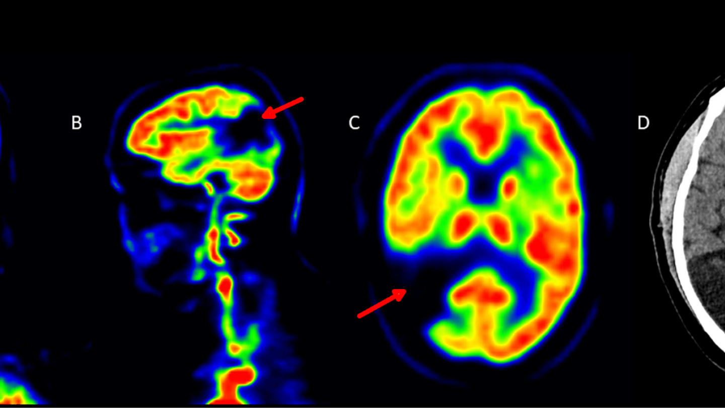 Aivoinfarkti näkyy nuolen osoittamissa paikoissa aivojen PET-kuvissa eri suunnista katsottuna.