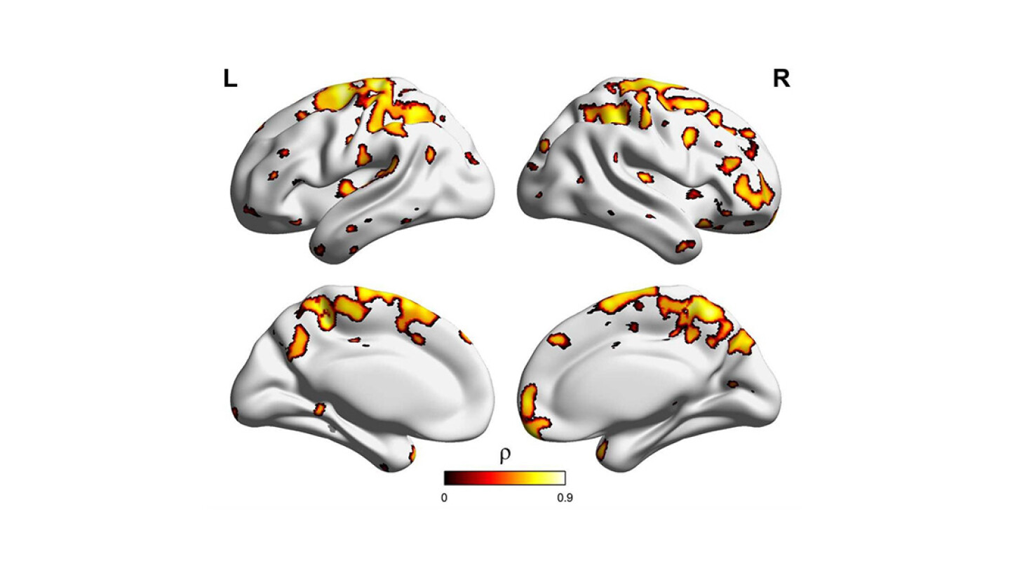PET-kuvassa väritettynä aivoalueet, joille amyloidia alkaa ensimmäiseksi kerääntyä Alzheimerin taudissa