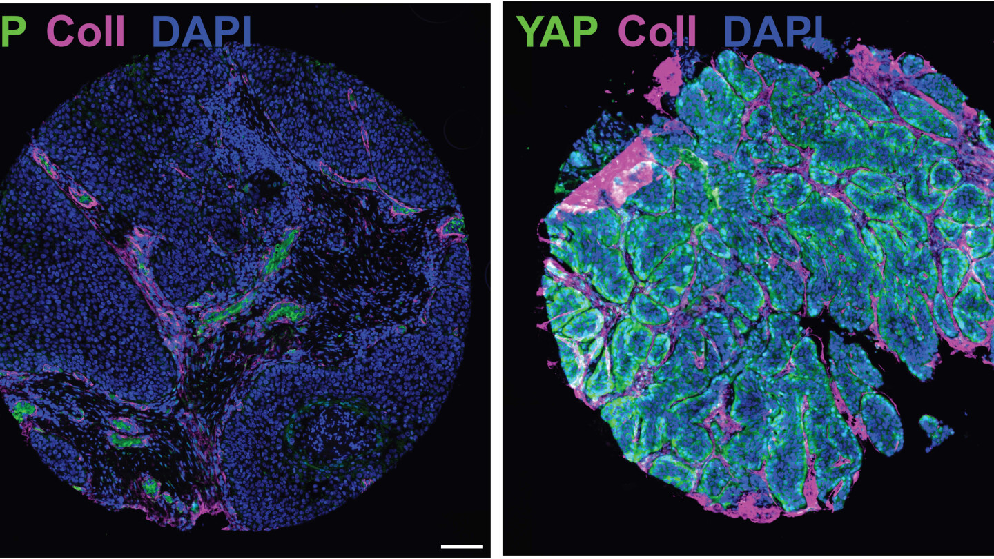 Mikroskooppikuva kurkunpääsyövästä