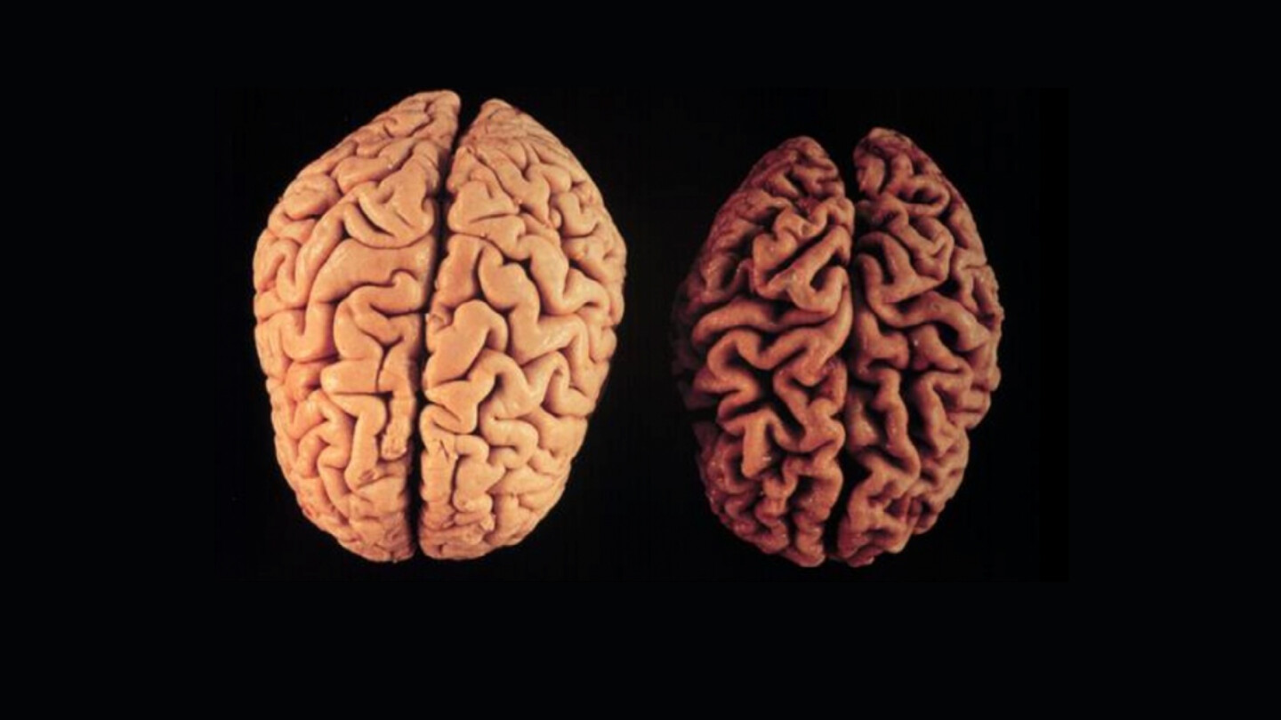 Valokuva terveistä ja MS-taudin edetessä kutistuneista aivoista.