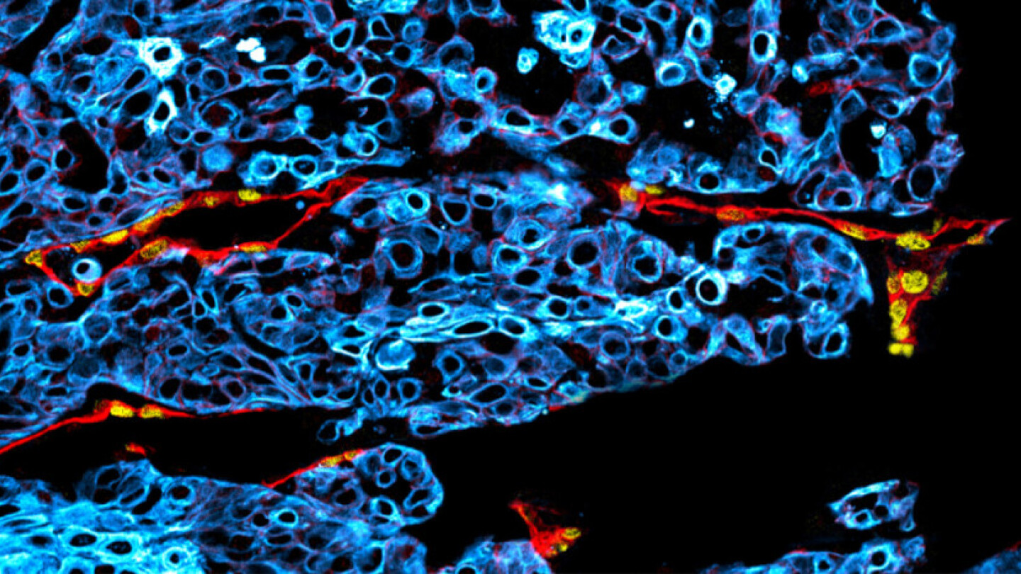 Mikroskooppikuva suusyövästä