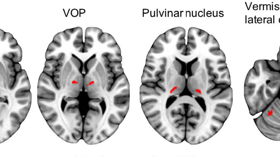Aivokuvat Holmesin vapinan aivoverkosta
