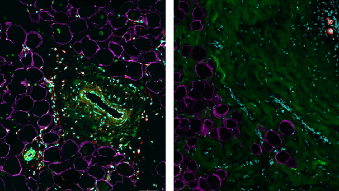 Rasvakudosta ja rintasyöpä