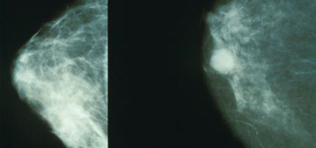 Mammo_breast_cancer_web.jpg