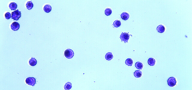 Makrofajea PAP-sairudessa