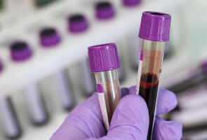kuvituskuvassa vaalean violettiin hanskaan verhoutunut käsi pitelee kahta verinäytettä laboratoriossa