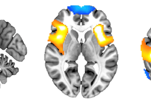 Aivokuvia, joihin on merkitty tutkijoiden tunnistamat aivoverkostot sinisellä ja kellertävällä värillä.
