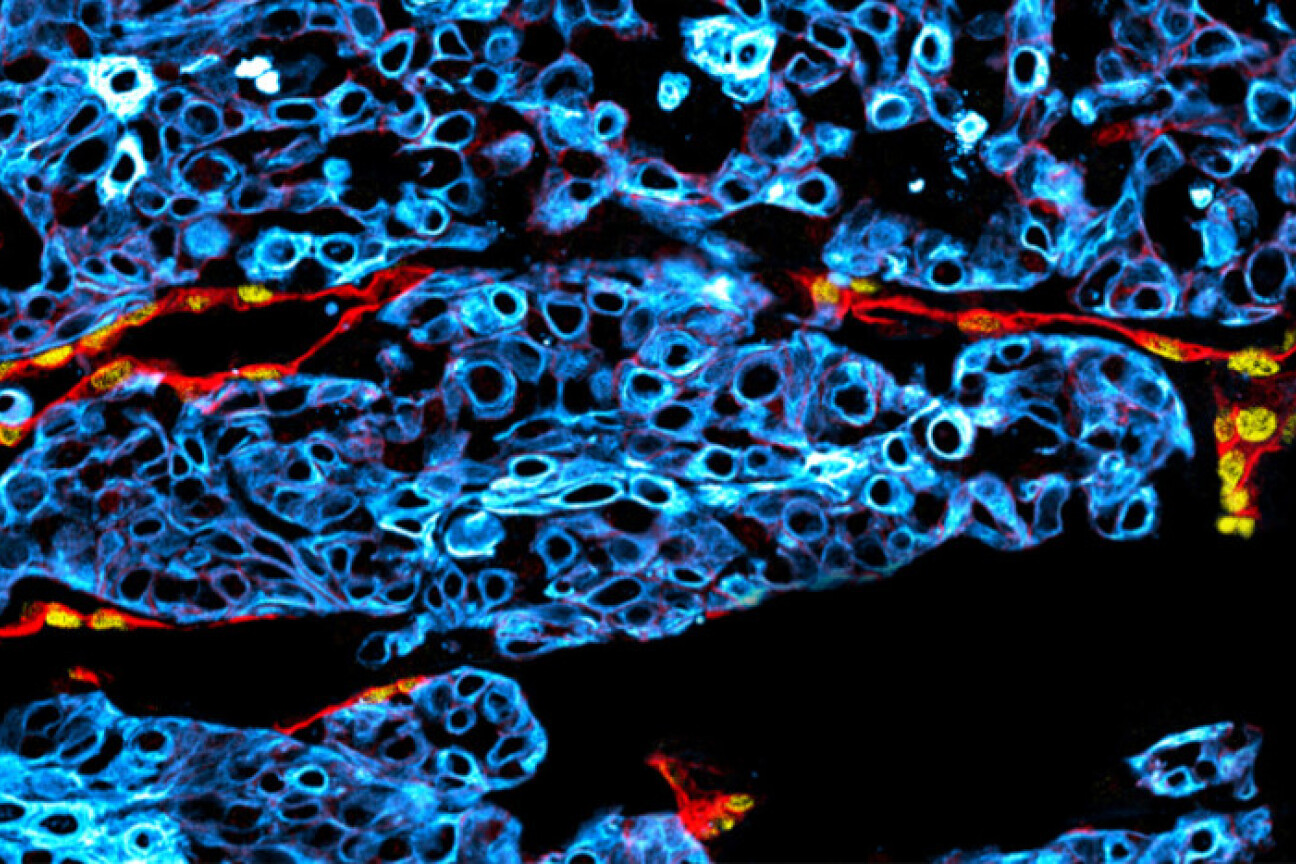 Mikroskooppikuva suusyövästä